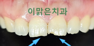 [심미보철]  파절된 앞니 라미네이트 치료 