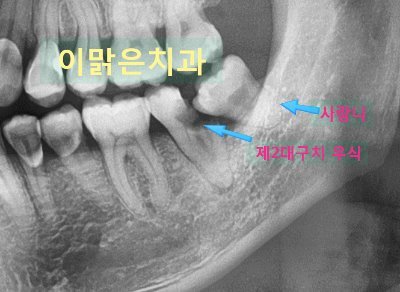 [임플란트]  사랑니 발치 후 임플란트