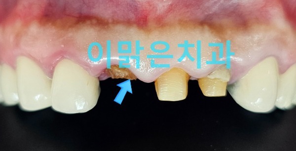  [보존치료, 심미보철] 뿌리만 남은 앞니 치아 살릴 수 있을까?