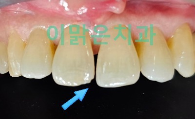 [보존치료, 심미치료] 벌어지고 깨진 앞니 레진 치료 