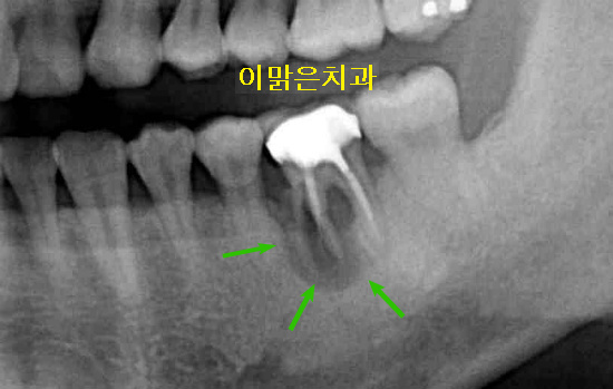 [임플란트] 임플란트 