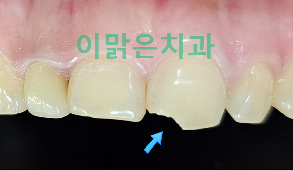 [보존치료, 심미치료] 파절된 앞니 레진치료
