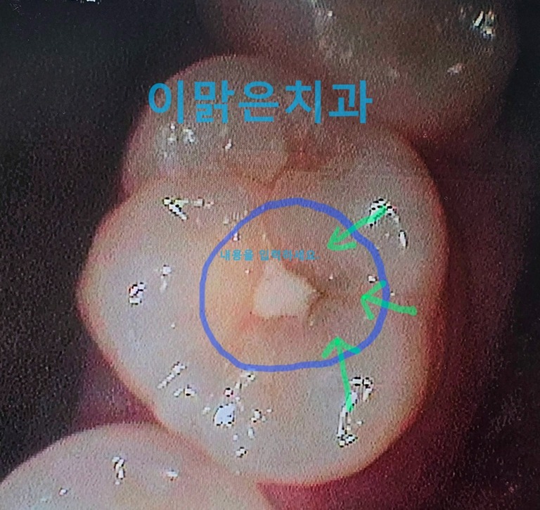  [보존치료] 충치, 정기검진과 조기 치료가 중요