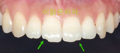 [치아성형] 파절된 앞니를 레진으로 치아성형