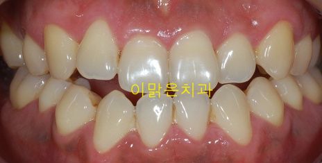 [치아미백] 치아미백