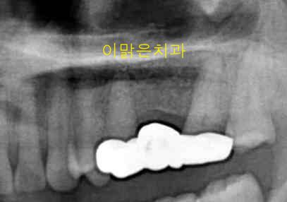  [임플란트] 임플란트