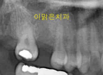  [임플란트] 임플란트