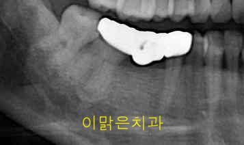 [임플란트] 임플란트