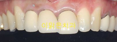 [심미보철] 앞니 보철 재치료