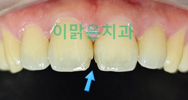 [보존치료, 심미치료] 앞니 레진 재치료