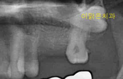 [임플란트] 임플란트