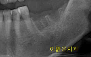 [임플란트] 임플란트
