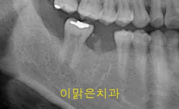 [임플란트] 임플란트