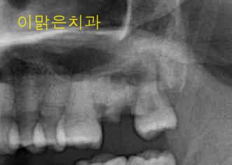   [임플란트] 임플란트