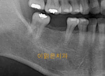   [임플란트] 임플란트