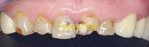 [보철치료] 앞니 심미보철
