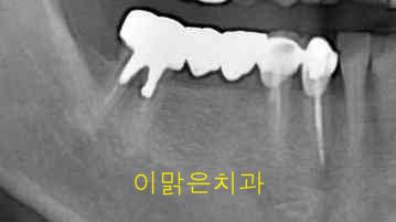 [임플란트] 임플란트
