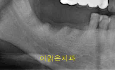 [임플란트] 임플란트