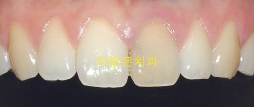 [심미보철] 변색된 앞니 올세라믹크라운으로 치료