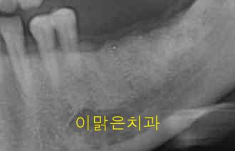   [임플란트] 임플란트