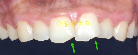 [앞니레진치료] 파절된 앞니 레진으로 치료