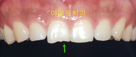 [레진치료] 파절된 앞니 레진으로 치료