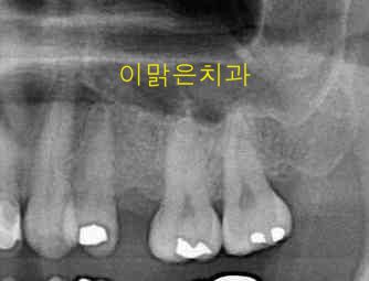 [임플란트] 임플란트
