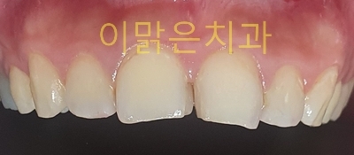  [치아성형, 심미보철] 앞니 보철 치료