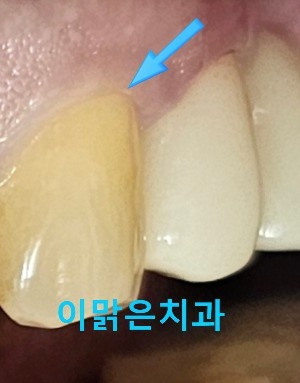 [치아미백]  치아 미백 