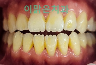 [치아미백]  치아 변색의 원인, 미백치료 