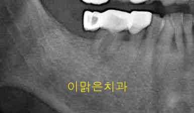   [임플란트] 임플란트
