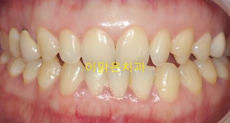   [치아미백] 치아미백