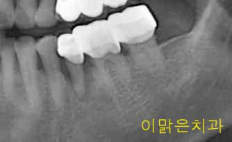 [임플란트] 임플란트