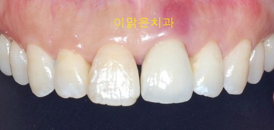 [치아성형] 비대칭 앞니 치아성형