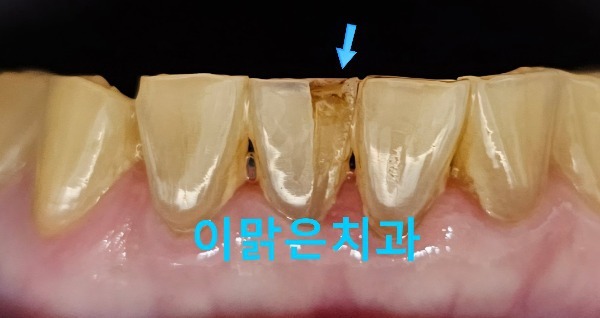  [심미보철] 손상된 앞니 올세라믹 크라운 치료