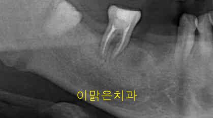   [임플란트] 임플란트