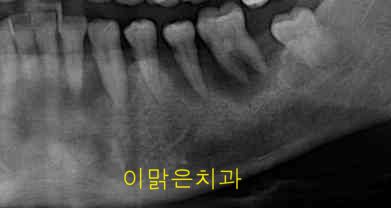   [임플란트] 임플란트