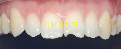[치아성형] 깨진 앞니 레진치료