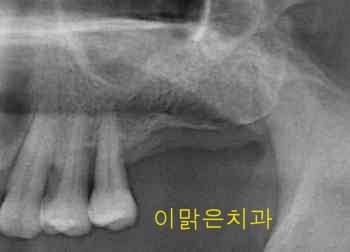 [임플란트] 임플란트