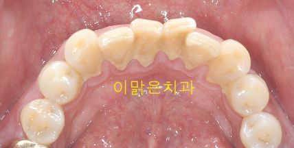 [잇몸치료] 스켈링 전 후 사진