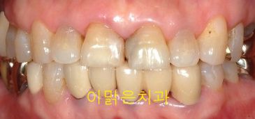 [치아성형] 앞니 충치 치료