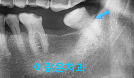 [임플란트]  어금니 임플란트 치료