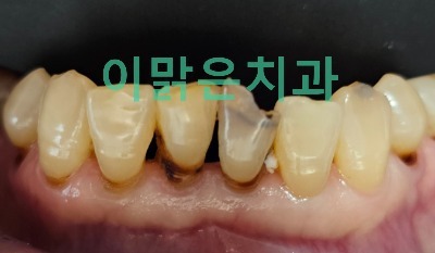  [심미보철] 아래 앞니 충치 보철 치료